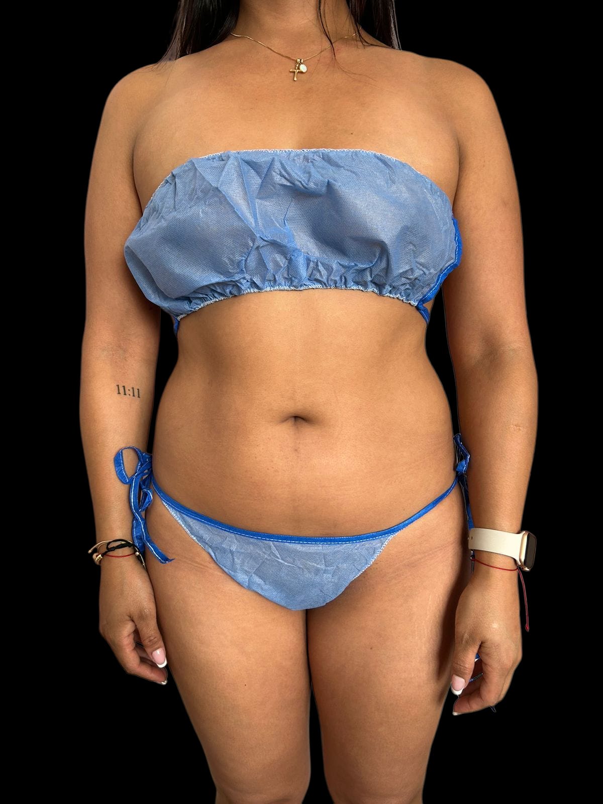 Lipoescultura 4k 360 en Colombia Medellin. Dra Ángeles Esmeral. Cirujano Plástico en Medellin Colombia (4)