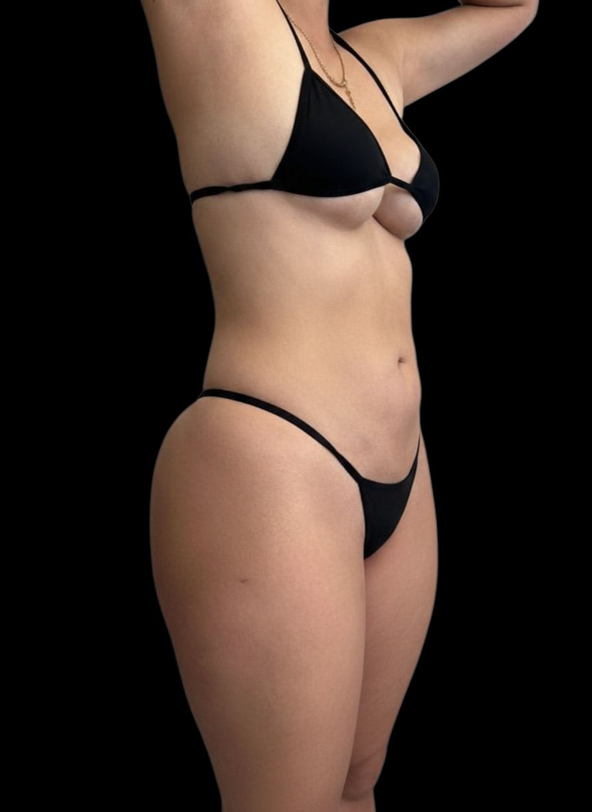 Lipoescultura 4k 360 en Colombia Medellin. Dra Ángeles Esmeral. Cirujano Plástico en Medellin Colombia (6)