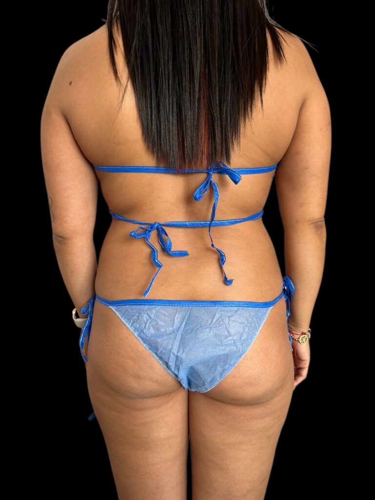 Lipoescultura 4k 360 en Colombia Medellin. Dra Ángeles Esmeral. Cirujano Plástico en Medellin Colombia (7)