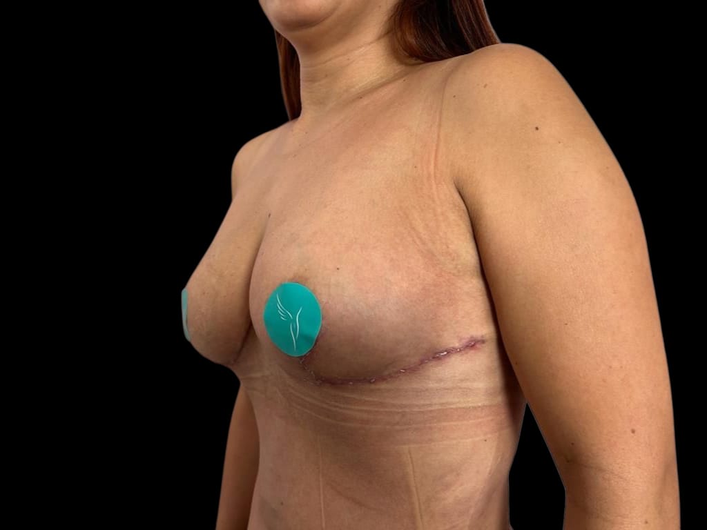 Mommy Makeover en Colombia Medellin. Dra Ángeles Esmeral. Cirujano Plástico en Medellin Colombia (12)