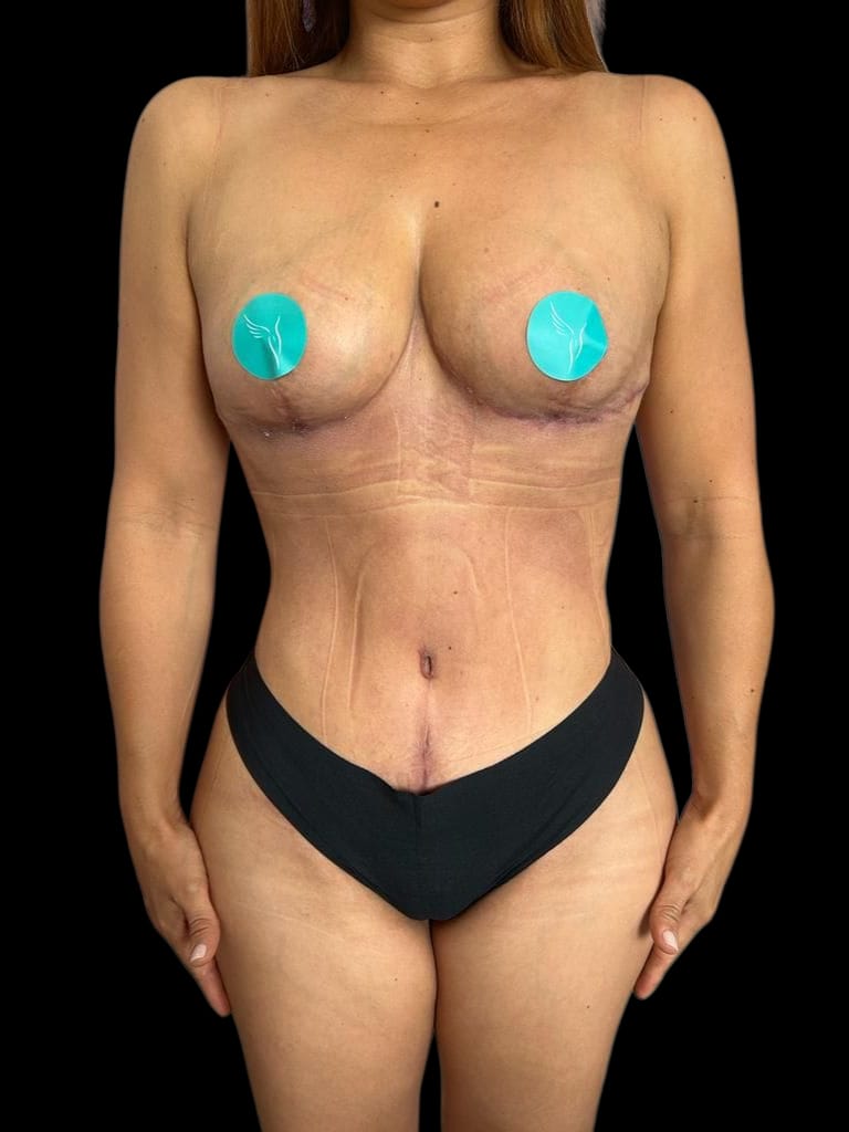 Mommy Makeover en Colombia Medellin. Dra Ángeles Esmeral. Cirujano Plástico en Medellin Colombia (14)