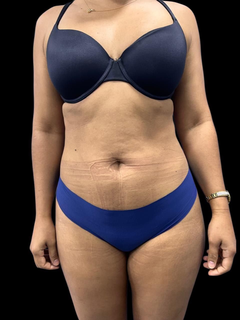 Mommy Makeover en Colombia Medellin. Dra Ángeles Esmeral. Cirujano Plástico en Medellin Colombia (3)