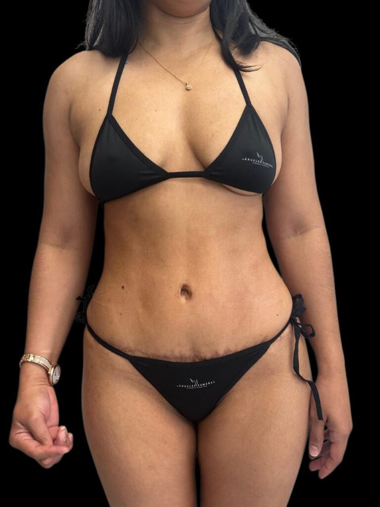 Mommy Makeover en Colombia Medellin. Dra Ángeles Esmeral. Cirujano Plástico en Medellin Colombia (4)