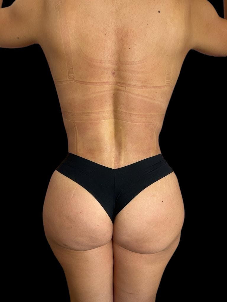 Mommy Makeover en Colombia Medellin. Dra Ángeles Esmeral. Cirujano Plástico en Medellin Colombia (6)