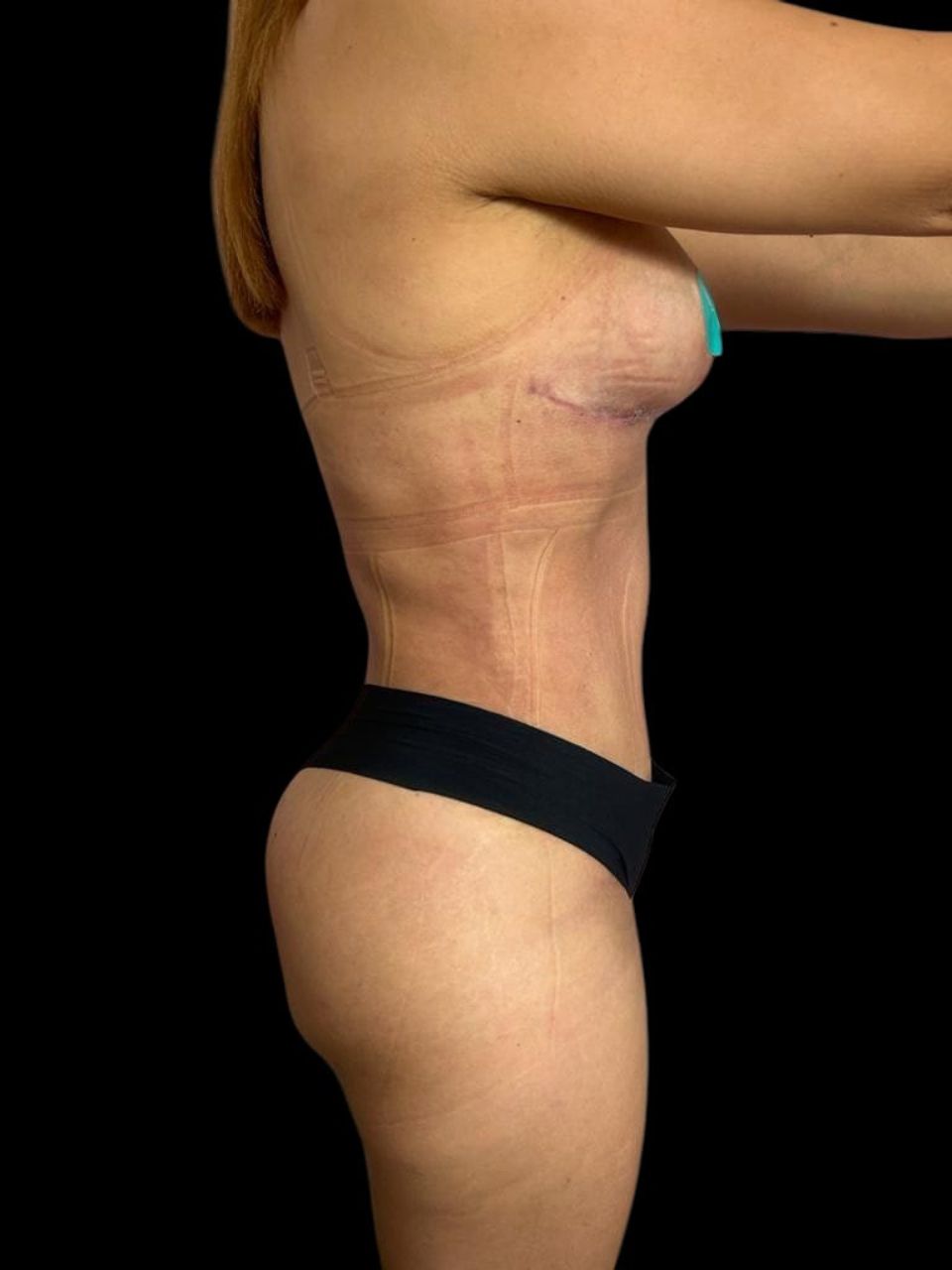 Mommy Makeover en Colombia Medellin. Dra Ángeles Esmeral. Cirujano Plástico en Medellin Colombia (6)