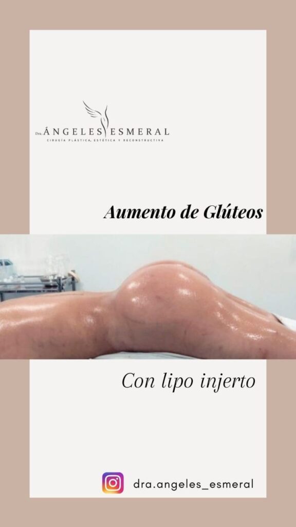 Lipotransferencia Glútea en Colombia. Dra Angeles Esmeral. Cirujana Plastico en Medellín Colombia 3